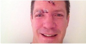 bakkies botha_suture